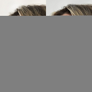 Деликатная FullFace-коррекция лица фото до и после 2