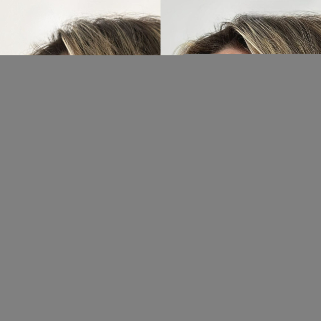 Деликатная FullFace-коррекция лица фото до и после 2