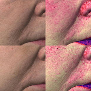 Биореструктуризация препаратом ARES Anti Oxidant фото до и после 2