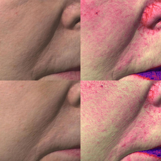Биореструктуризация препаратом ARES Anti Oxidant фото до и после 2