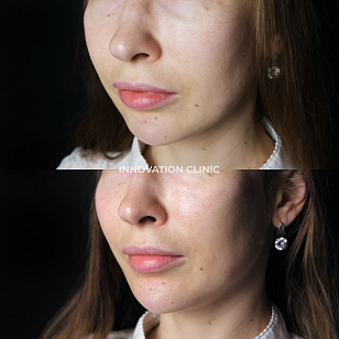 Коррекция подбородка филлером фото до и после 2