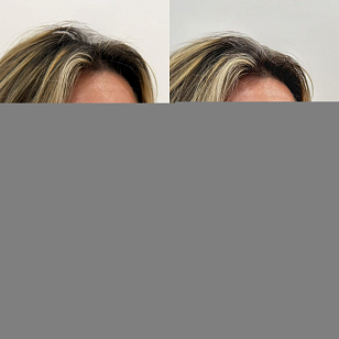 Деликатная FullFace-коррекция лица фото до и после 3
